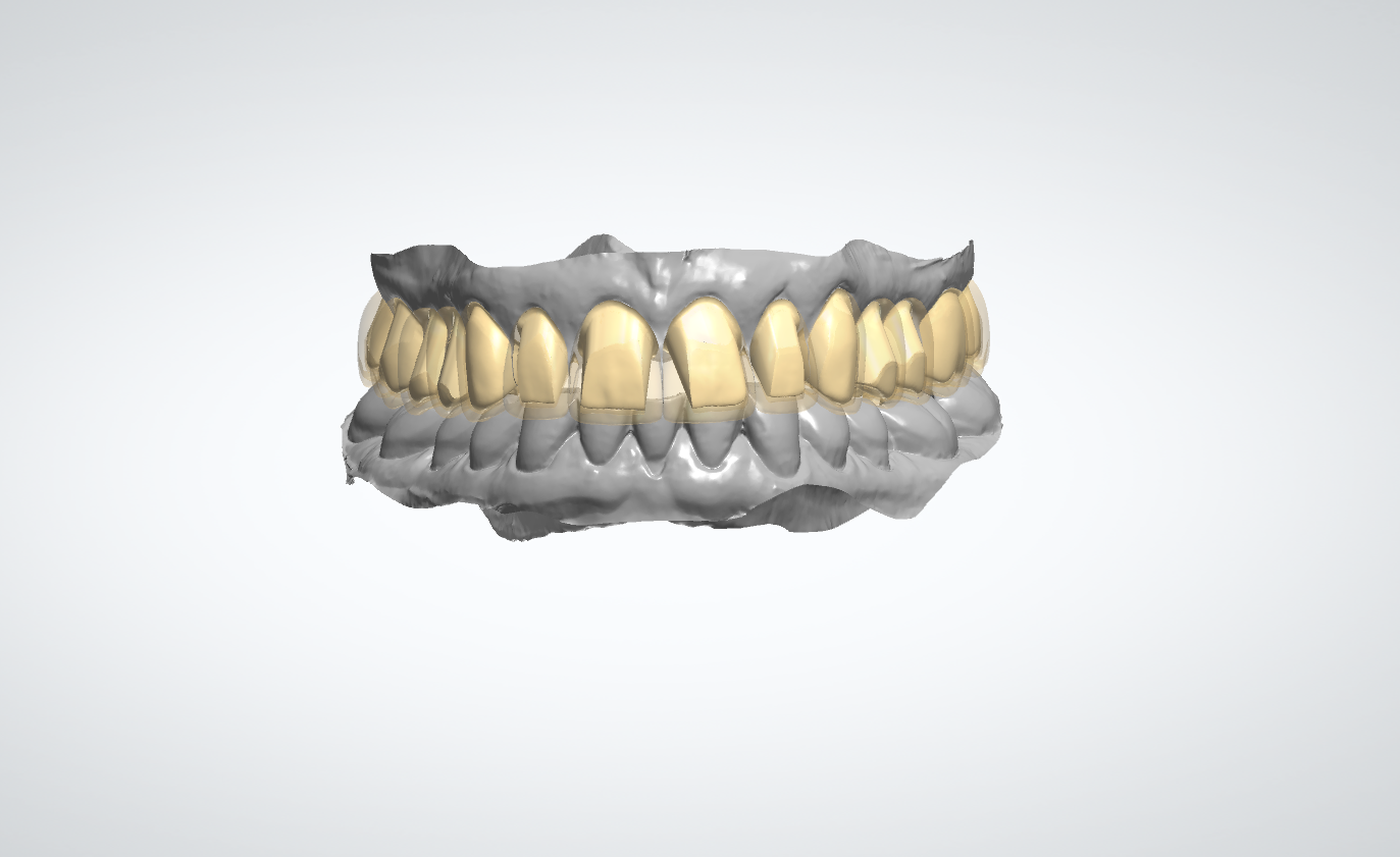 Digital Wax-Up Design